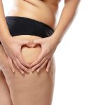 tratar estrías de forma natural